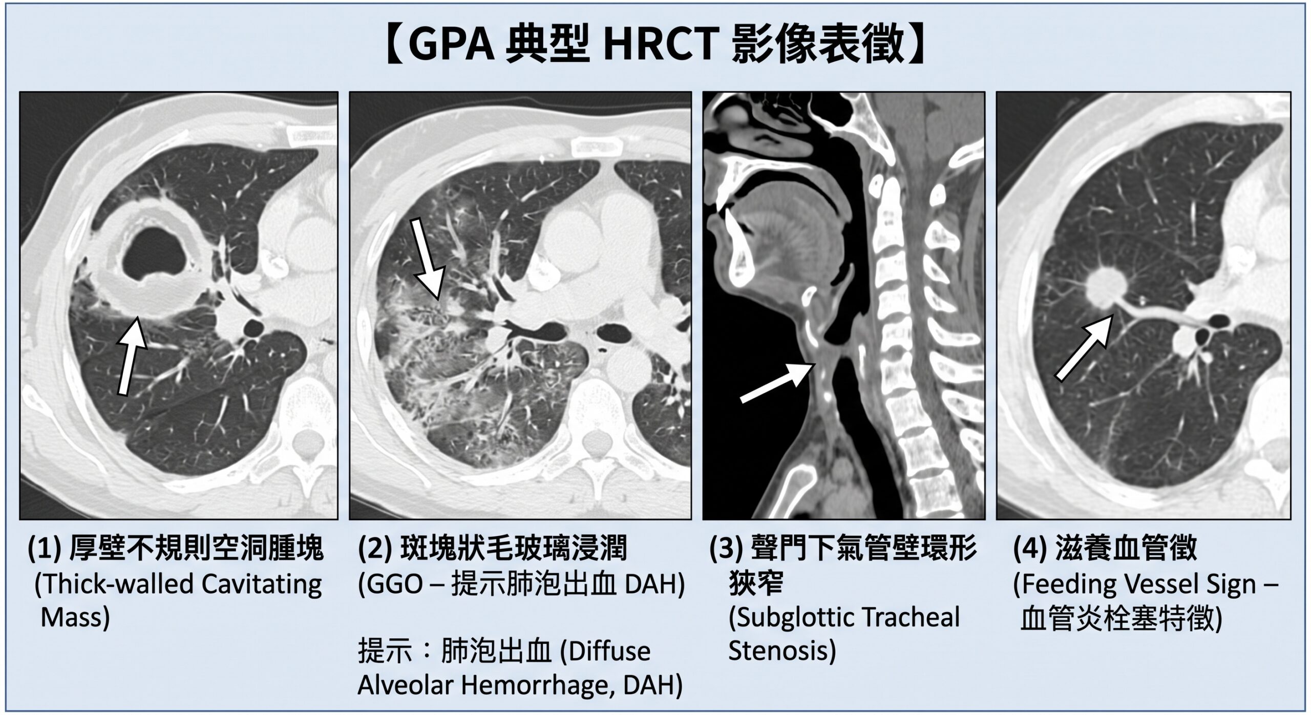 GPA HRCT 影像診斷特徵