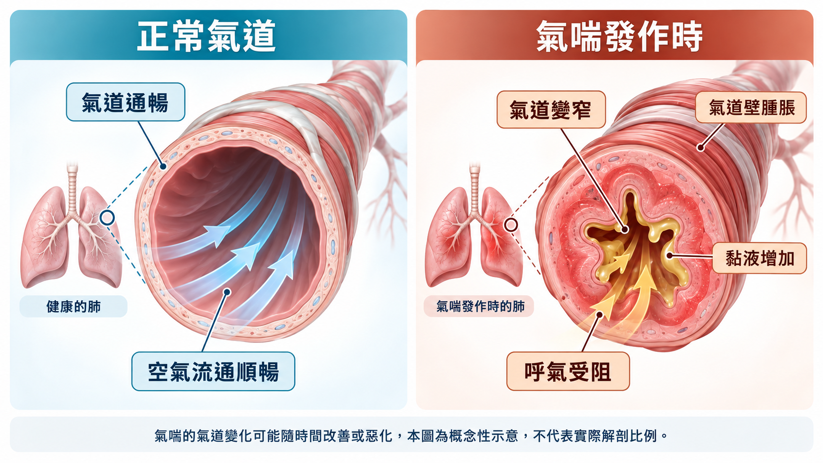 氣喘氣道變化示意圖